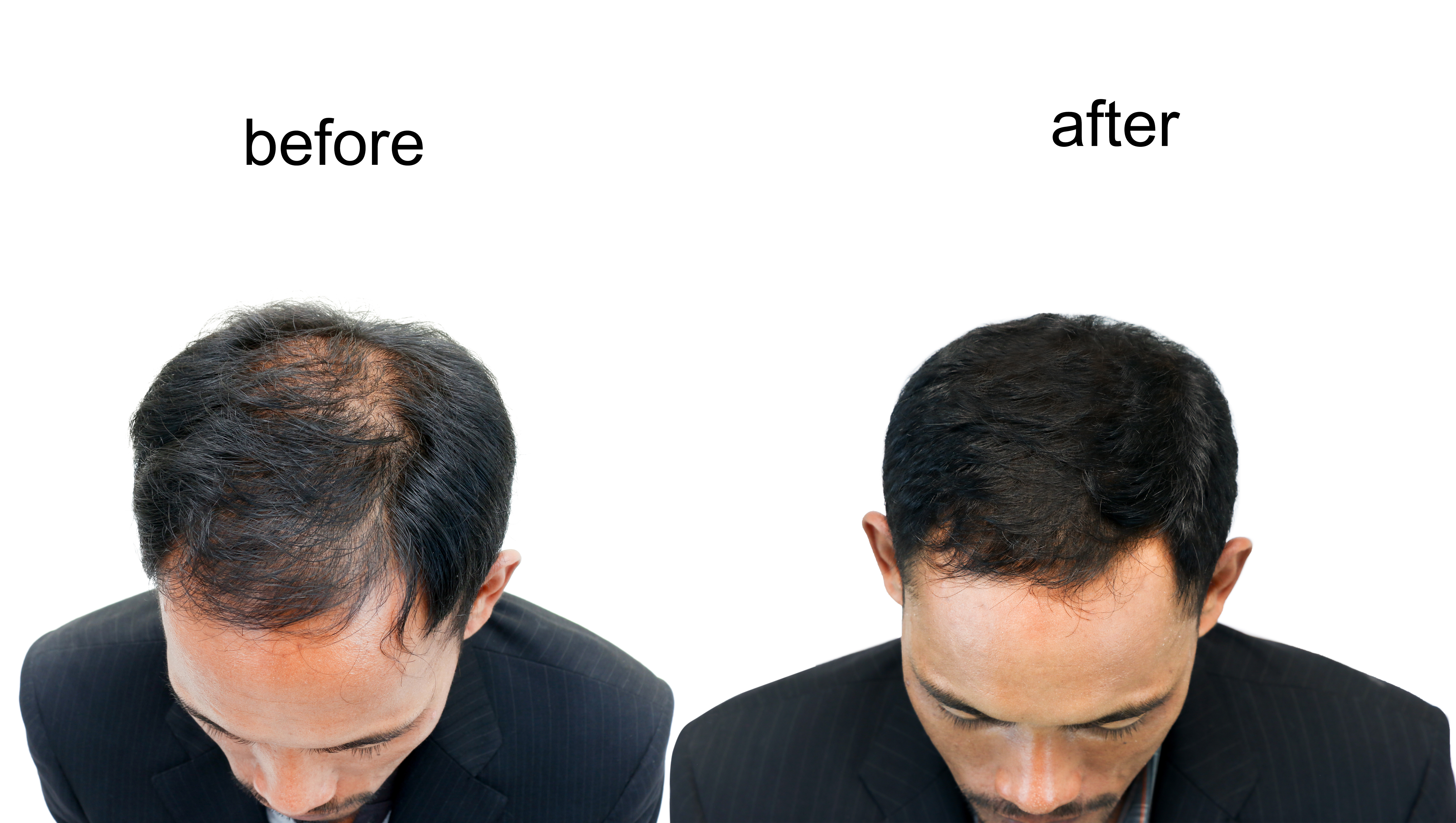  before and after bald head of a man on white background.